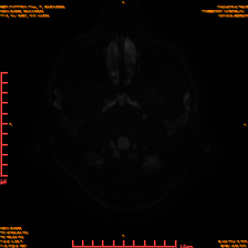 2025-06-14/sDWI B1000/0003-IM942.png