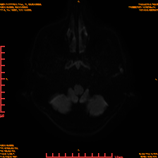 2025-06-14/sDWI B1000/0004-IM943.png