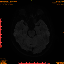 2025-06-14/sDWI B1000/0010-IM949.png
