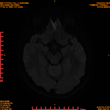 2025-06-14/sDWI B1000/0011-IM950.png
