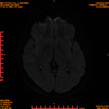2025-06-14/sDWI B1000/0013-IM952.png
