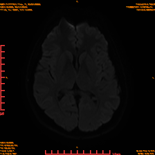 2025-06-14/sDWI B1000/0014-IM953.png