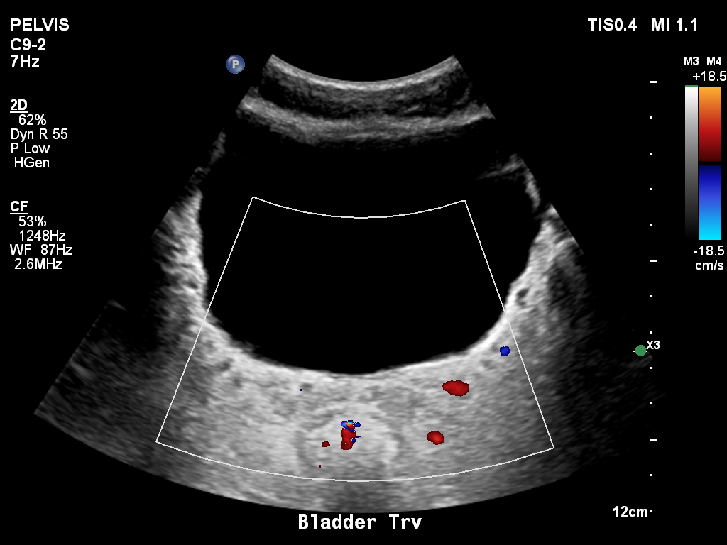 2025-11-03/Bladder Ultrasound/0003-.png