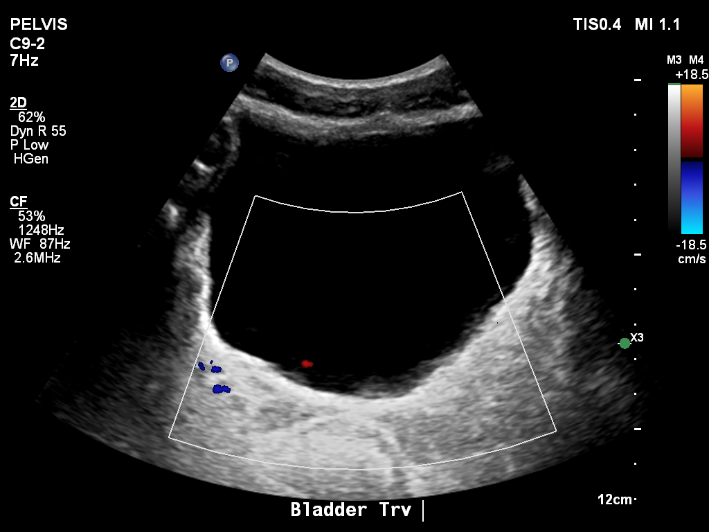 2025-11-03/Bladder Ultrasound/0004-.png