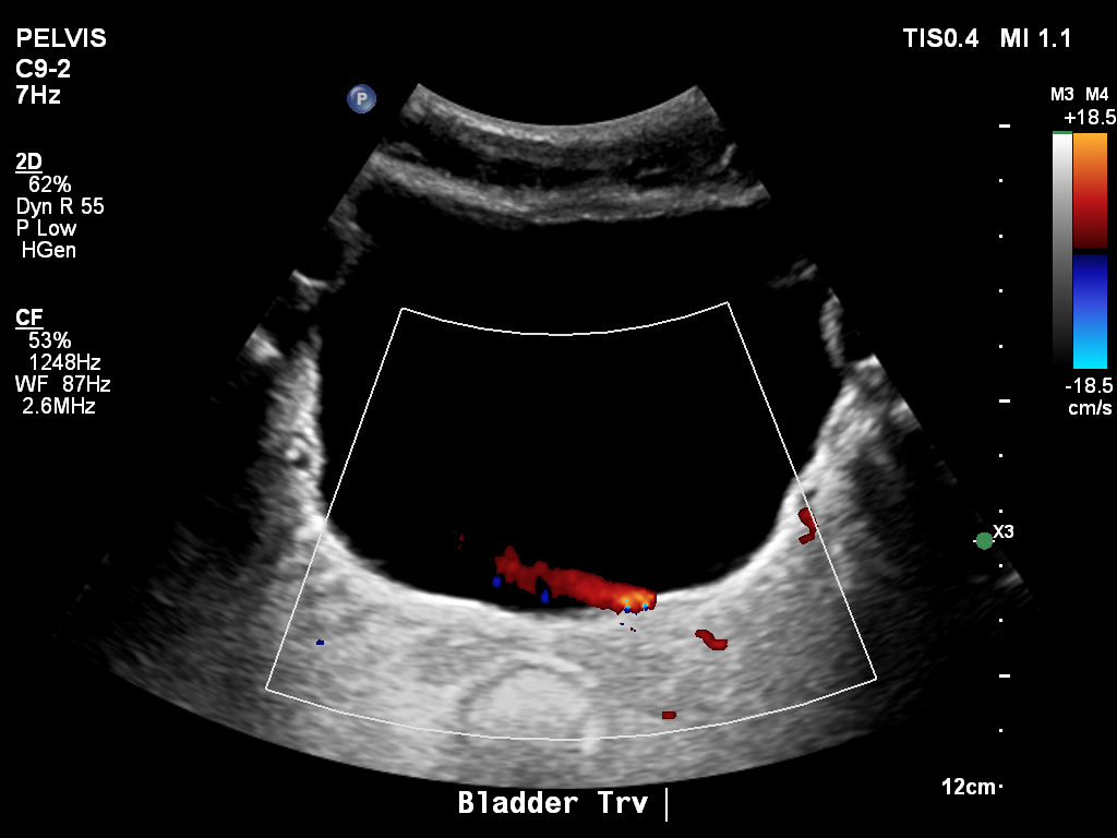2025-11-03/Bladder Ultrasound/0005-.png