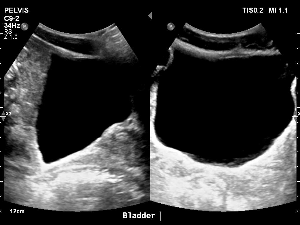 2025-11-03/Bladder Ultrasound/0006-.png