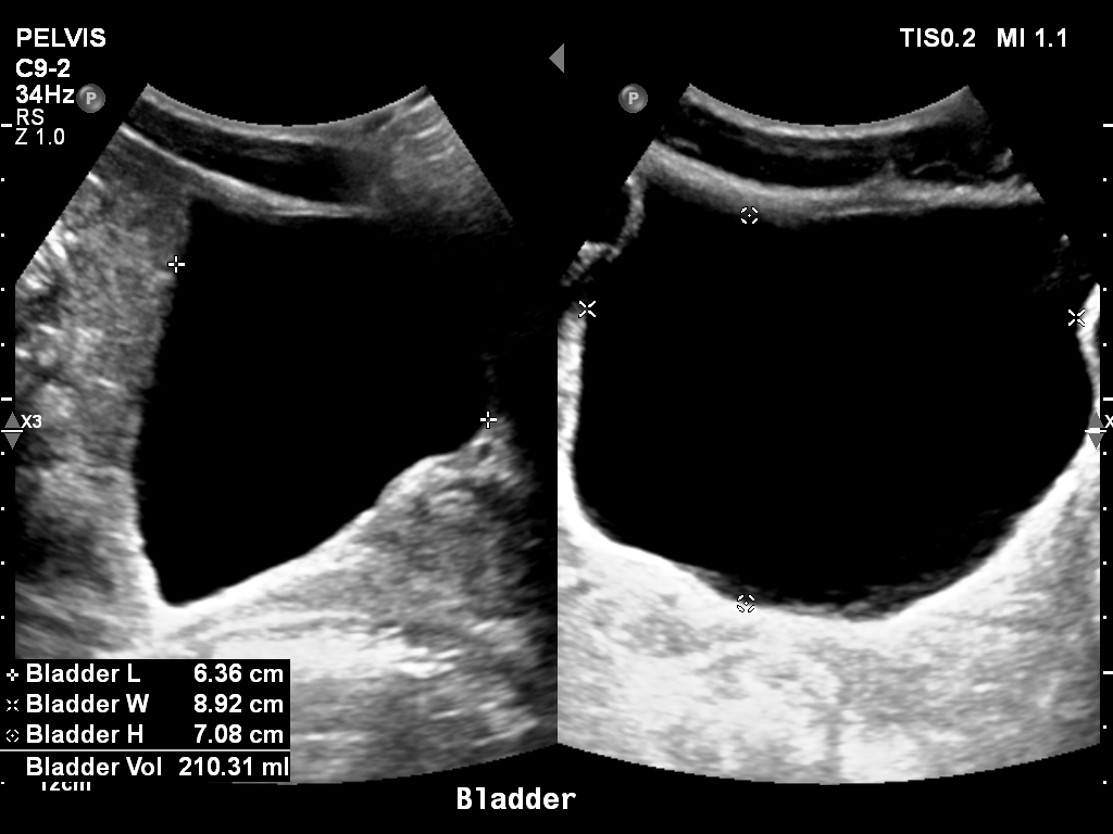 2025-11-03/Bladder Ultrasound/0007-.png