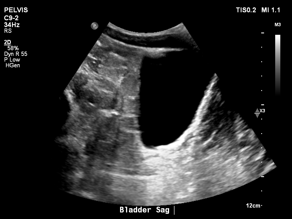 2025-11-03/Bladder Ultrasound/0009-.png