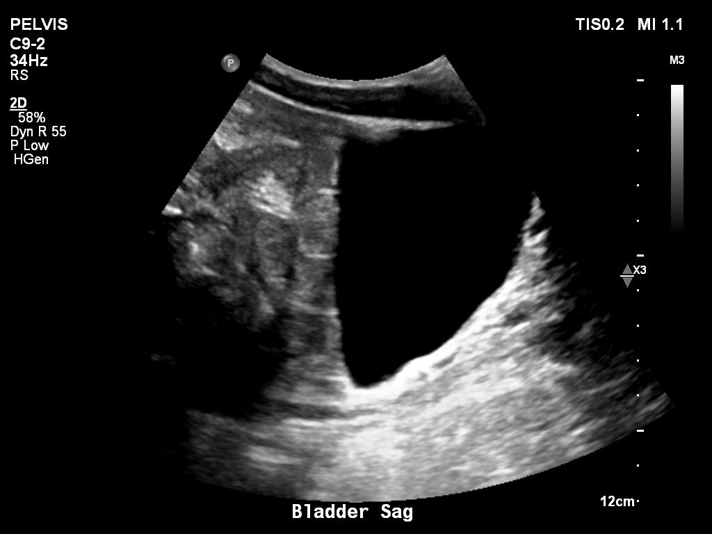 2025-11-03/Bladder Ultrasound/0010-.png