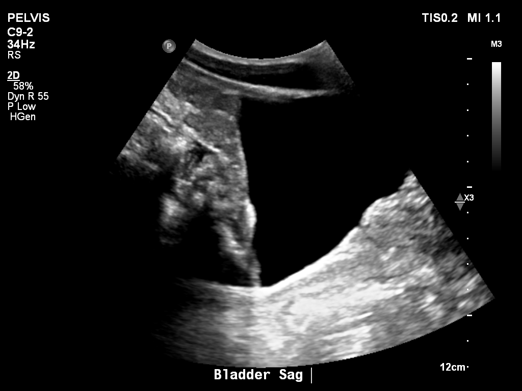 2025-11-03/Bladder Ultrasound/0011-.png