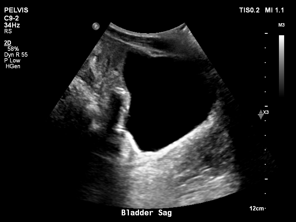2025-11-03/Bladder Ultrasound/0012-.png