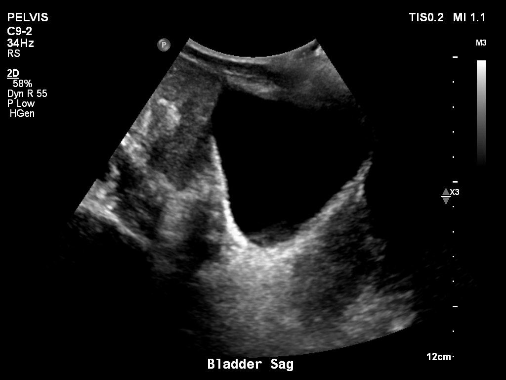 2025-11-03/Bladder Ultrasound/0013-.png
