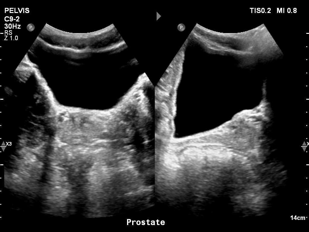 2025-11-03/Bladder Ultrasound/0014-.png
