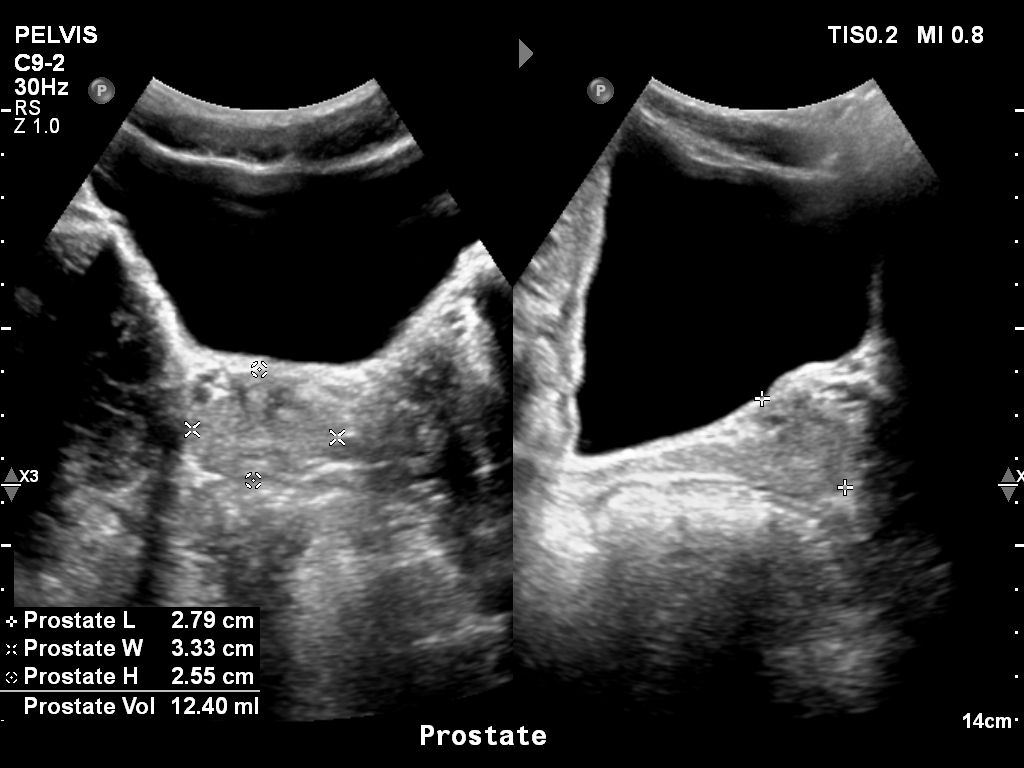 2025-11-03/Bladder Ultrasound/0015-.png