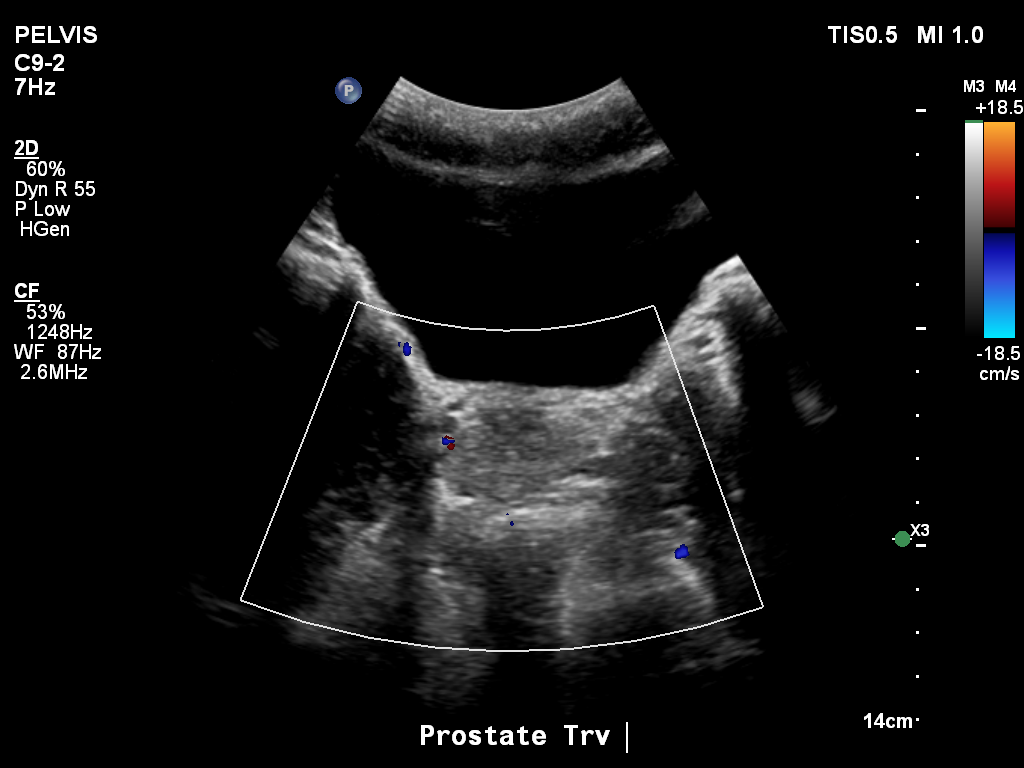 2025-11-03/Bladder Ultrasound/0016-.png