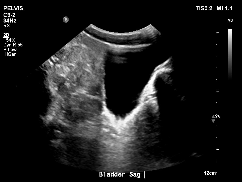 2025-11-03/Bladder Ultrasound/0018-.png