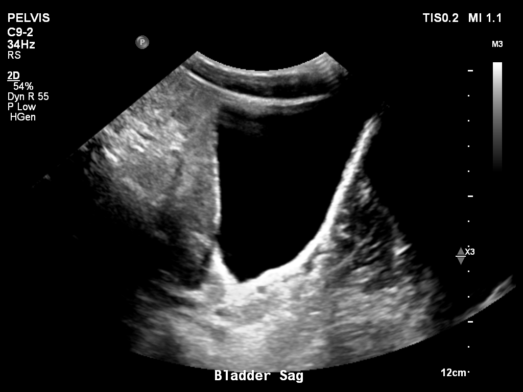 2025-11-03/Bladder Ultrasound/0019-.png