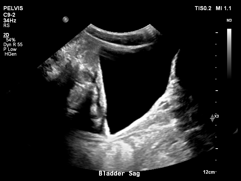 2025-11-03/Bladder Ultrasound/0020-.png