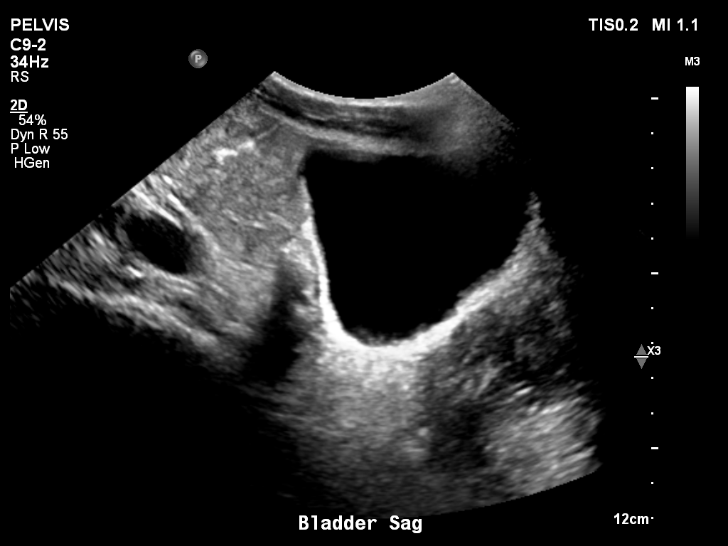 2025-11-03/Bladder Ultrasound/0022-.png