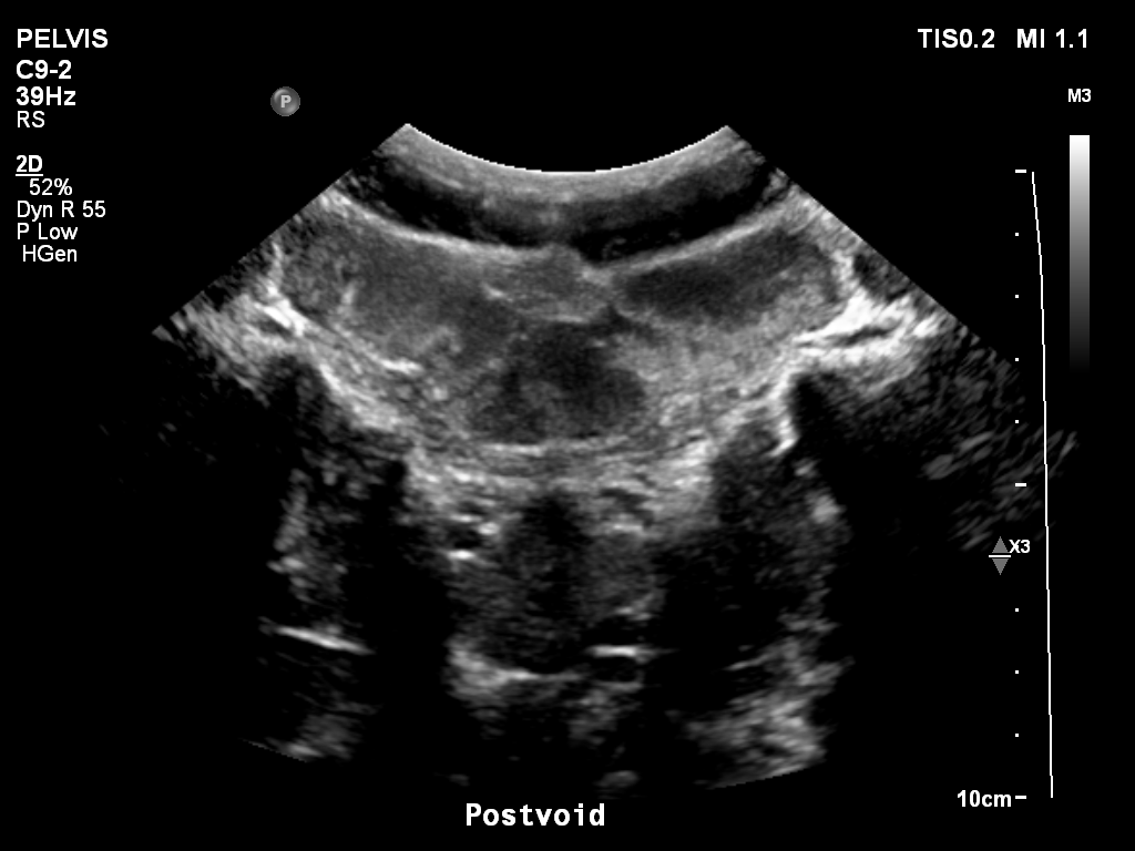 2025-11-03/Bladder Ultrasound/0023-.png