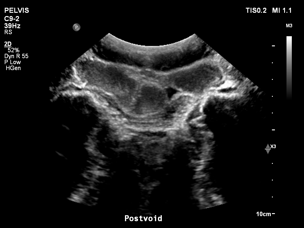 2025-11-03/Bladder Ultrasound/0024-.png