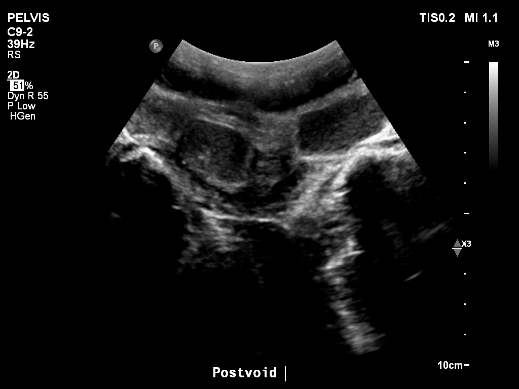2025-11-03/Bladder Ultrasound/0028-.png