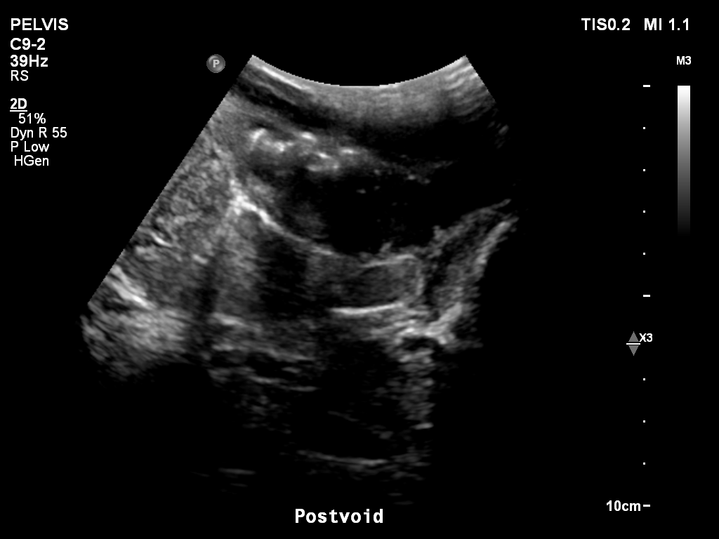 2025-11-03/Bladder Ultrasound/0029-.png