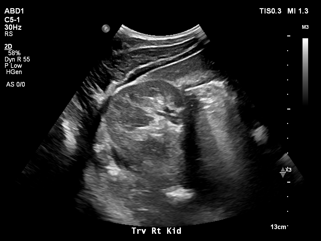 2025-11-03/Kidneys Ultrasound/0007-.png