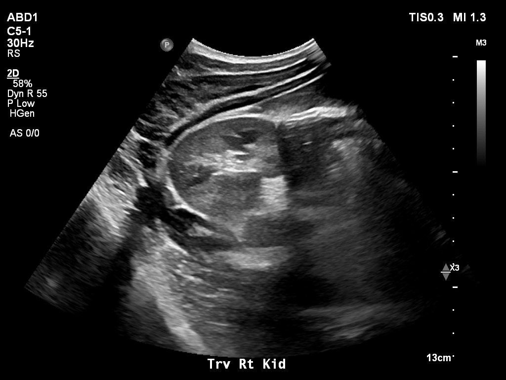 2025-11-03/Kidneys Ultrasound/0008-.png