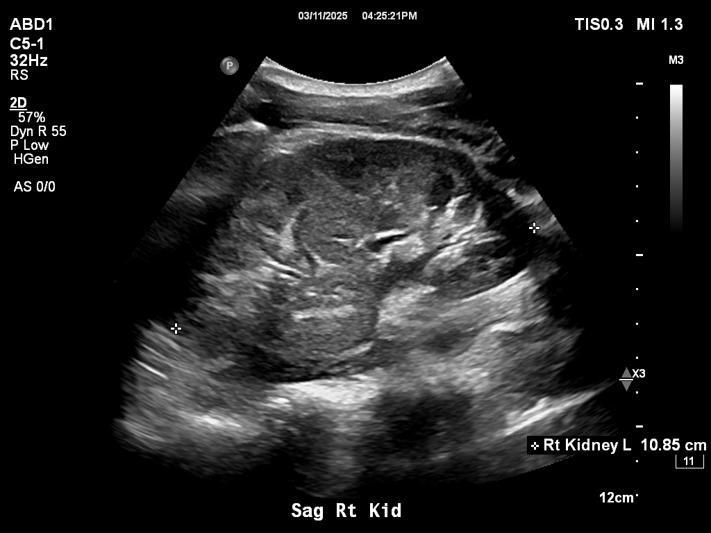 2025-11-03/Kidneys Ultrasound/0011-.png