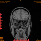 2026-04-15/Brain/AAHead_Scout_MPR_cor/0001-IM152.png