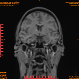 2026-04-15/Brain/AAHead_Scout_MPR_cor/0002-IM153.png