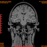 2026-04-15/Brain/AAHead_Scout_MPR_cor/0003-IM154.png