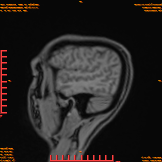 2026-04-15/Brain/AAHead_Scout_MPR_sag/0001-IM147.png
