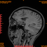 2026-04-15/Brain/AAHead_Scout_MPR_sag/0002-IM148.png