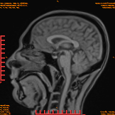 2026-04-15/Brain/AAHead_Scout_MPR_sag/0003-IM149.png
