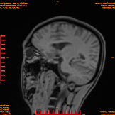 2026-04-15/Brain/AAHead_Scout_MPR_sag/0004-IM150.png