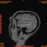 2026-04-15/Brain/AAHead_Scout_MPR_sag/0005-IM151.png