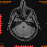 2026-04-15/Brain/AAHead_Scout_MPR_tra/0001-IM155.png