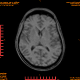 2026-04-15/Brain/AAHead_Scout_MPR_tra/0002-IM156.png