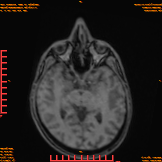 2026-04-15/Brain/AAHead_Scout_MPR_tra/0003-IM157.png
