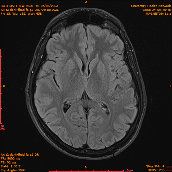 2026-04-15/Brain/Ax t2 dark-fluid fs p2 DR/0016-IM203.png