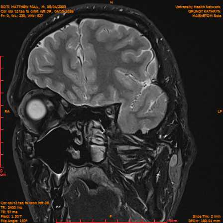 2026-04-15/Brain/Cor obl t2 tse fs orbit left DR/0001-IM232.png