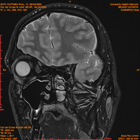 2026-04-15/Brain/Cor obl t2 tse fs orbit left DR/0002-IM233.png