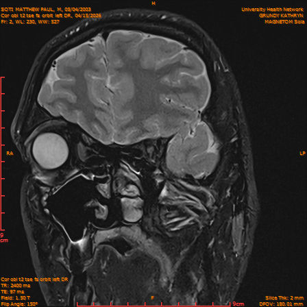 2026-04-15/Brain/Cor obl t2 tse fs orbit left DR/0003-IM234.png