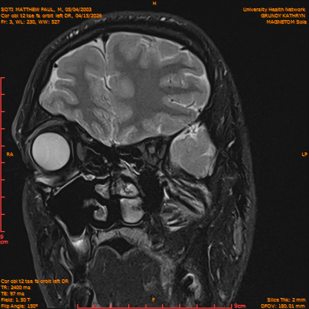 2026-04-15/Brain/Cor obl t2 tse fs orbit left DR/0004-IM235.png