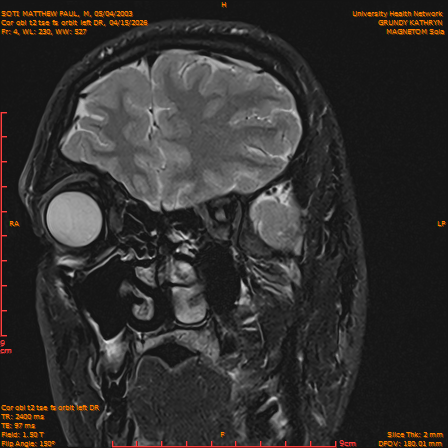 2026-04-15/Brain/Cor obl t2 tse fs orbit left DR/0005-IM236.png