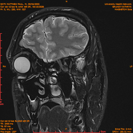 2026-04-15/Brain/Cor obl t2 tse fs orbit left DR/0006-IM237.png