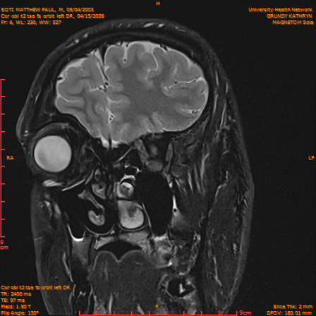 2026-04-15/Brain/Cor obl t2 tse fs orbit left DR/0007-IM238.png