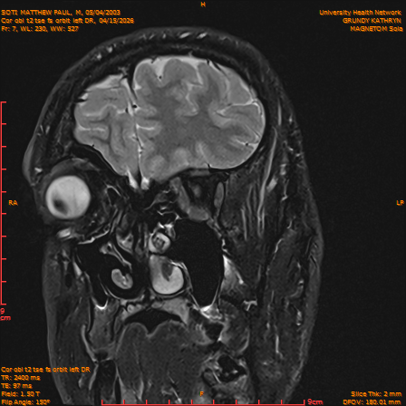 2026-04-15/Brain/Cor obl t2 tse fs orbit left DR/0008-IM239.png